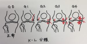 【変形性膝関節症のグレード分類】治療に必要な取捨選択とは？