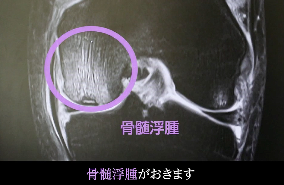 骨髄浮腫を起こした膝関節のMRI画像
